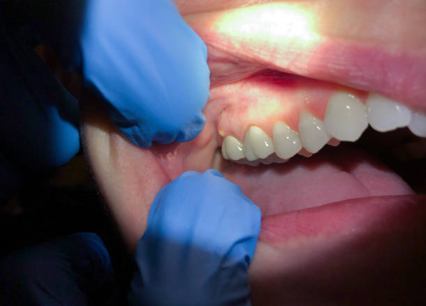 Best Emergency Root Canal Treatment in Fletcher, NC